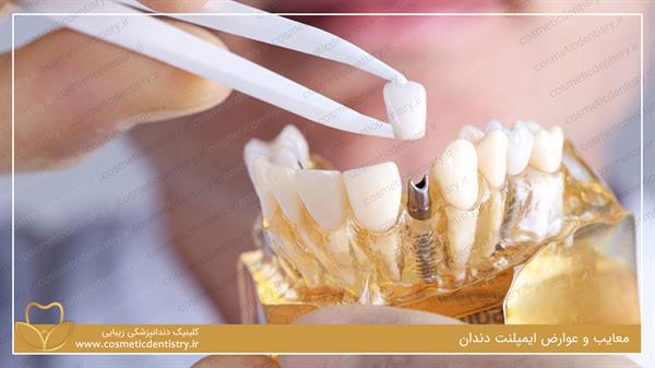 معایب و عوارض ایمپلنت دندان