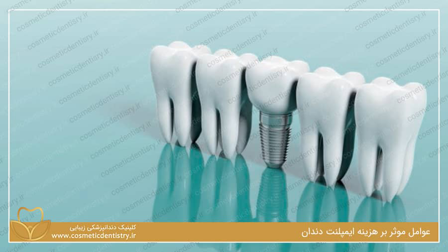 عوامل موثر بر هزینه ایمپلنت دندان