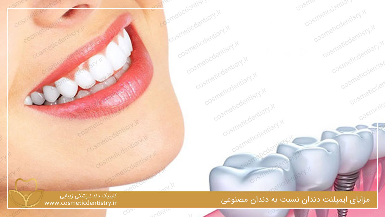 مزایای ایمپلنت دندان نسبت به دندان مصنوعی