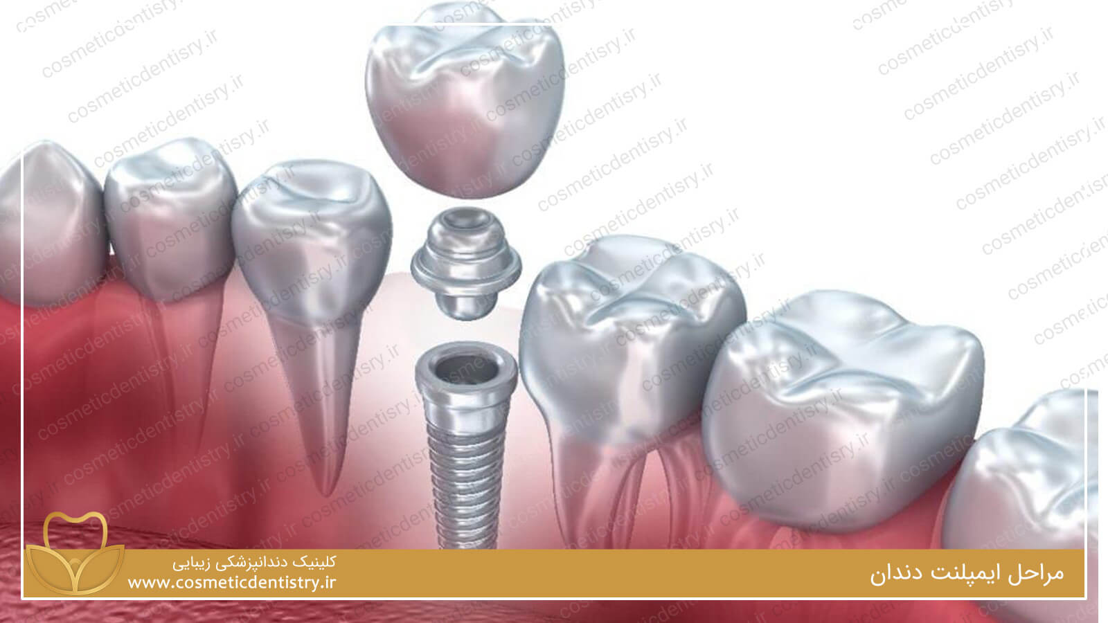  مراحل ایمپلنت دندان