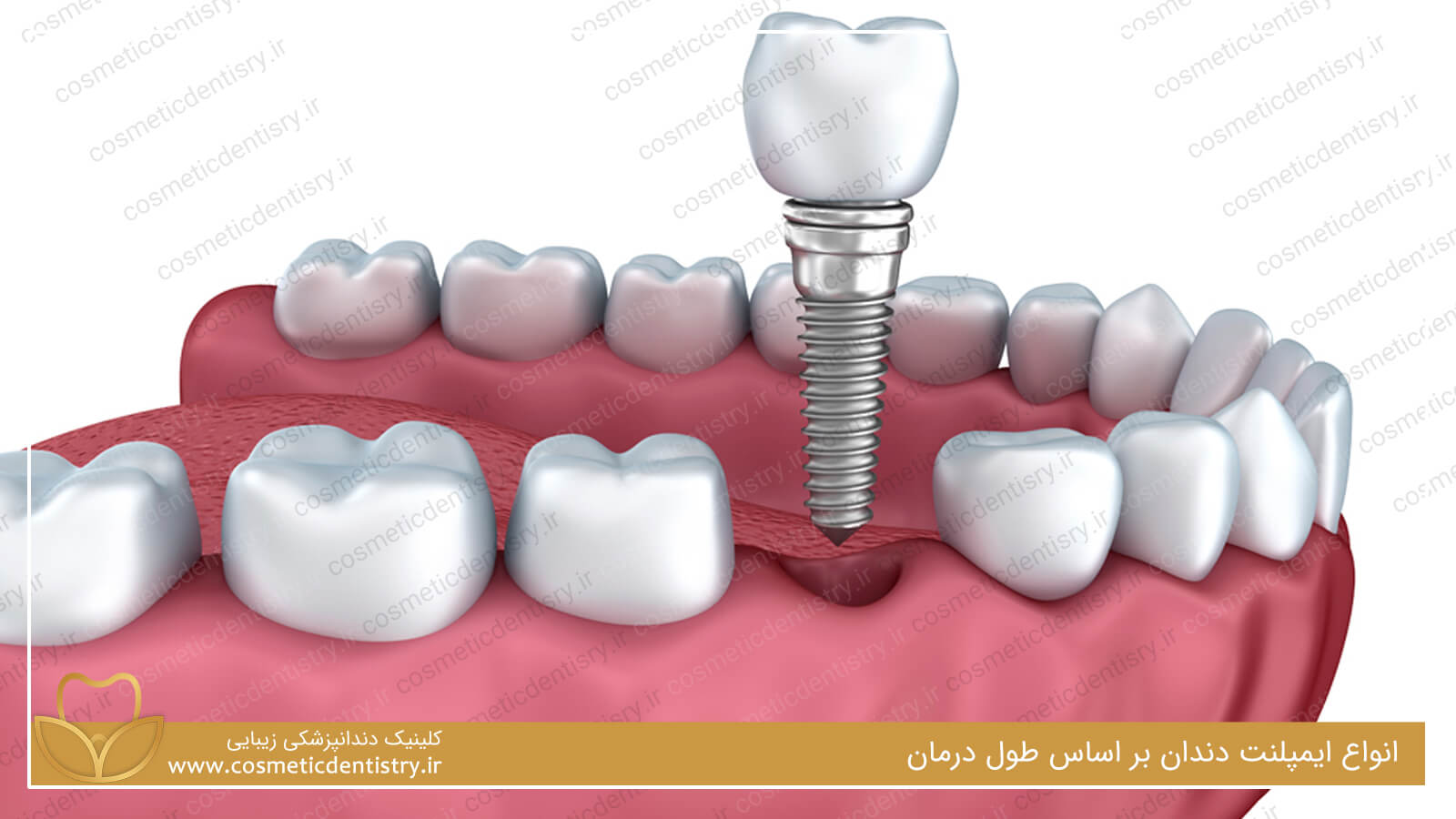 انواع ایمپلنت دندان بر اساس طول درمان