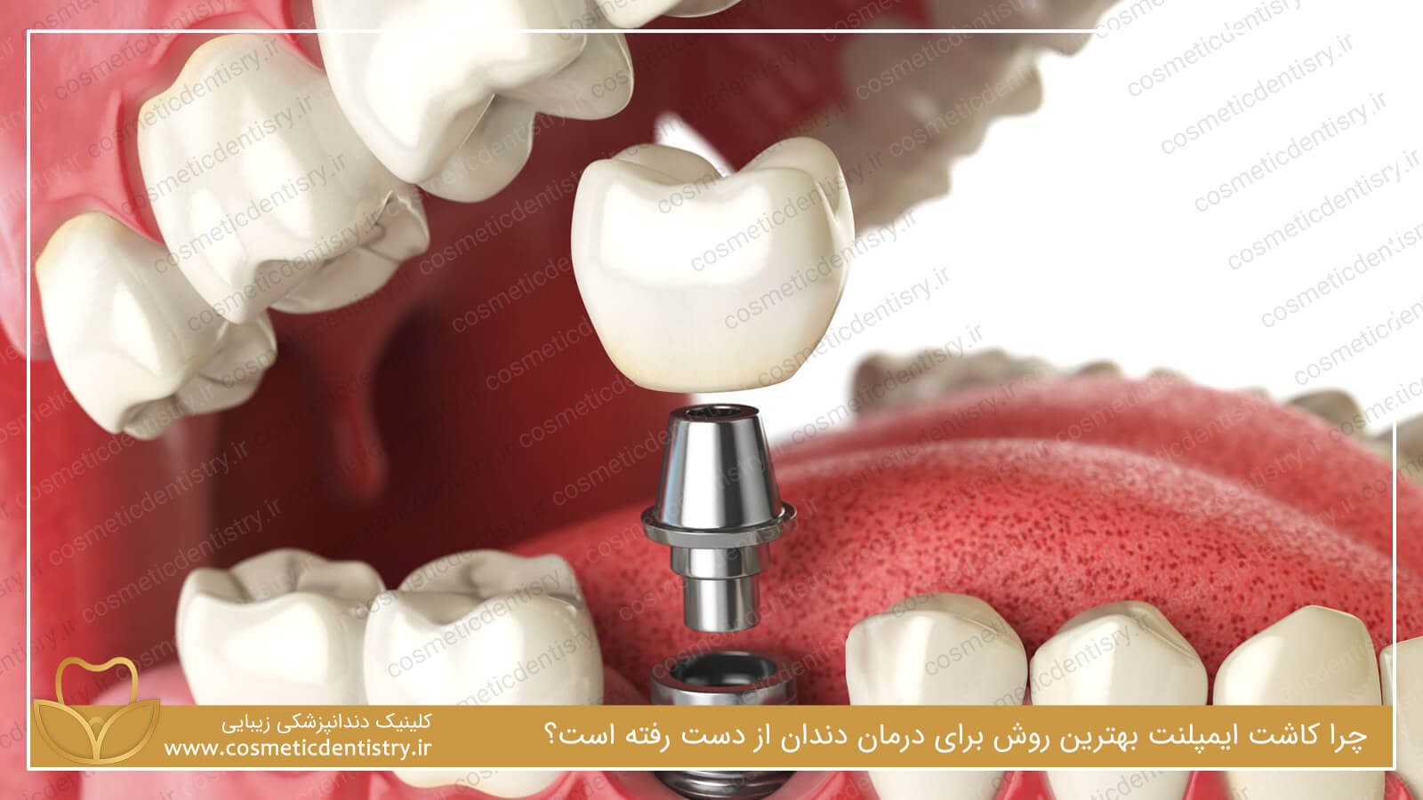 چرا کاشت ایمپلنت بهترین روش برای درمان دندان از دست رفته است؟