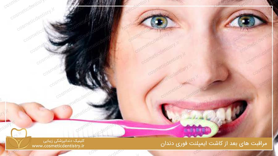 مراقبت های بعد از کاشت ایمپلنت فوری دندان