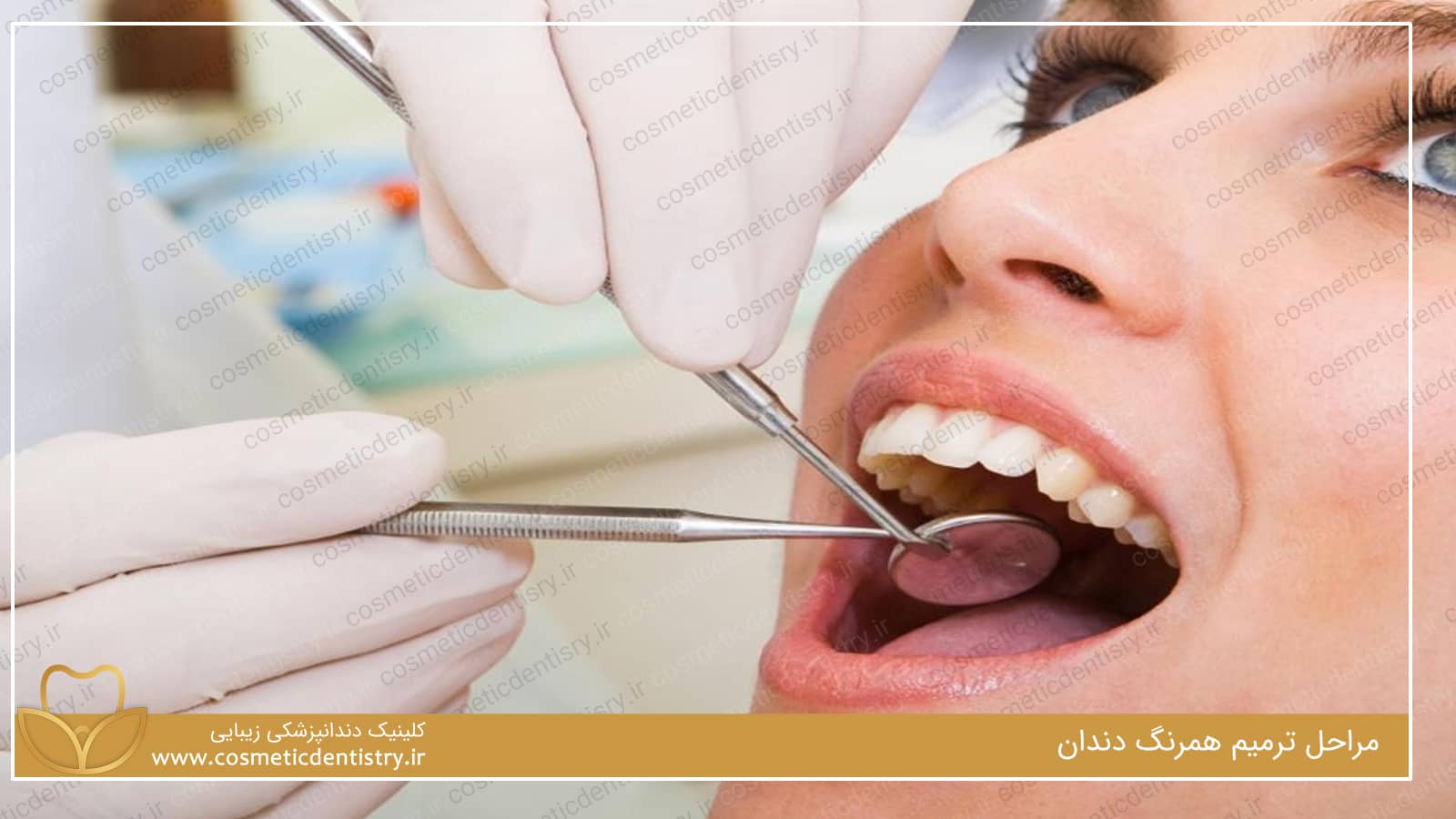 مراحل ترمیم همرنگ دندان