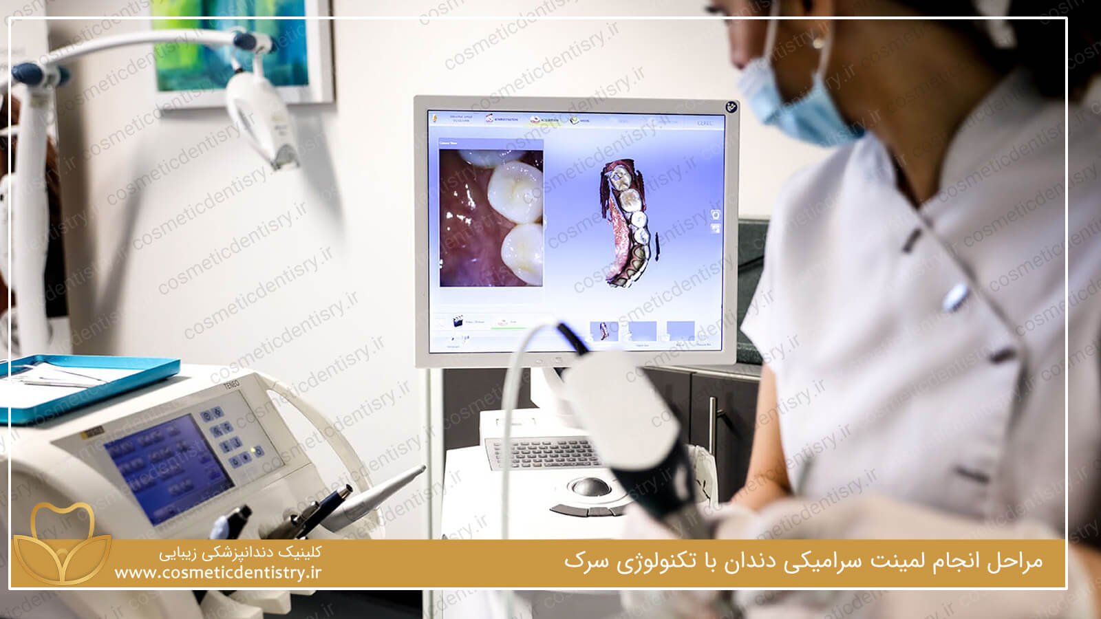 مراحل انجام لمینت سرامیکی دندان با تکنولوژی سرک