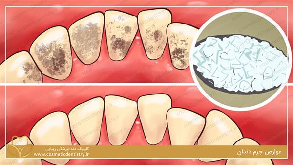 عوارض جرم دندان