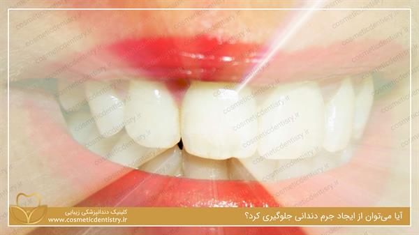 جلوگیری از بروز جرم دندان
