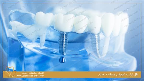 علل نیاز به تعویض ایمپلنت دندان