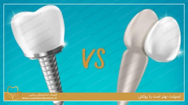تفاوت ایمپلنت و روکش دندان