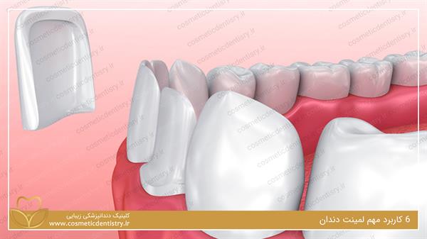 کاربردهای لمینت دندان